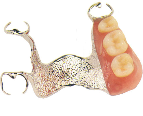 Partial dentures